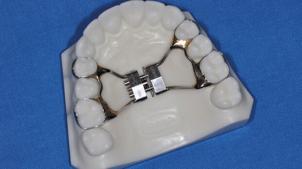Espansione del mascellare superiore con il Leaf Expander®