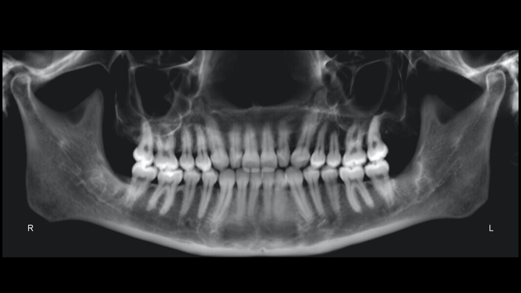 Fig. 19: Pretreatment panoramic radiograph.