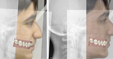 Il controllo del torque  degli incisivi superiori con  Invisalign: un case report