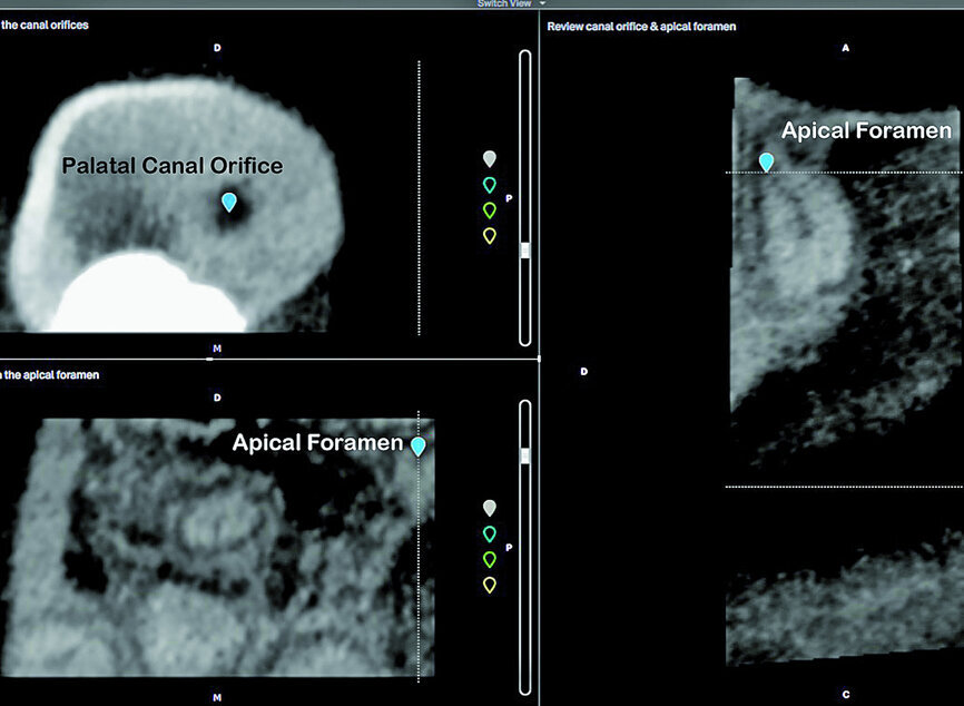 Fig. 6: Identification of the palatal canal orifice and radiographic apical foramen.
