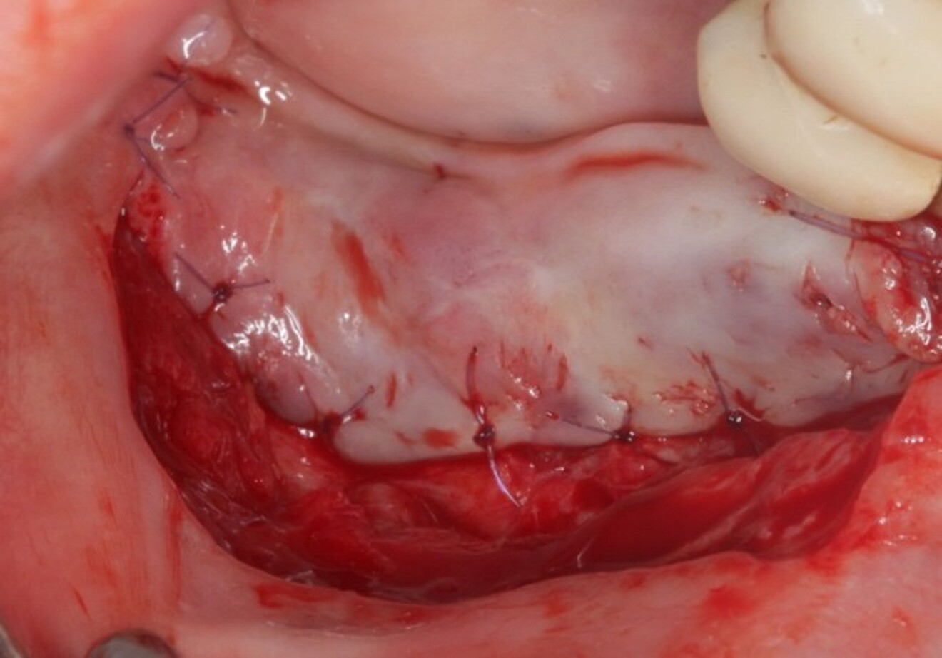 Correction of a shallow vestibule by Kazanjian vestibuloplasty, performed concurrently with implant placement.