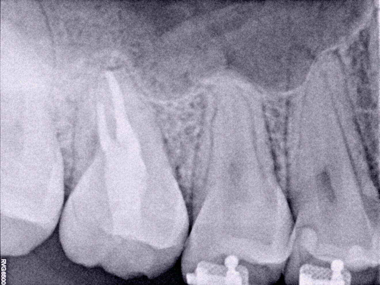 Fig. 11 : Radiographie de suivi après trois ans. La zone périapicale est cicatrisée.