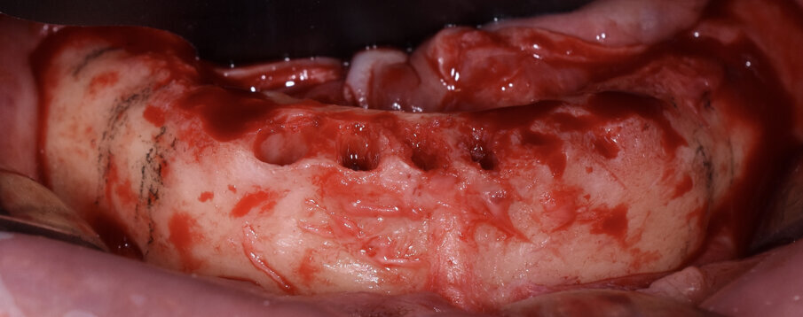 Fig. 6 - Ostectomia e regolarizzazione della cresta.