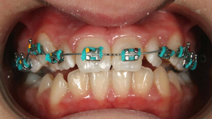 Jak zjednodušit léčebný protokol použitím drátu čtyřhranného průřezu v první fázi léčby