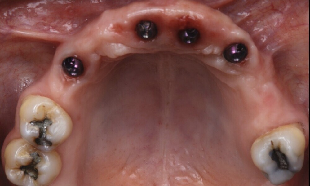 Figs. 76 & 77: Optimal soft tissue conditions were observed, indicating readiness for the definitive restorations. 