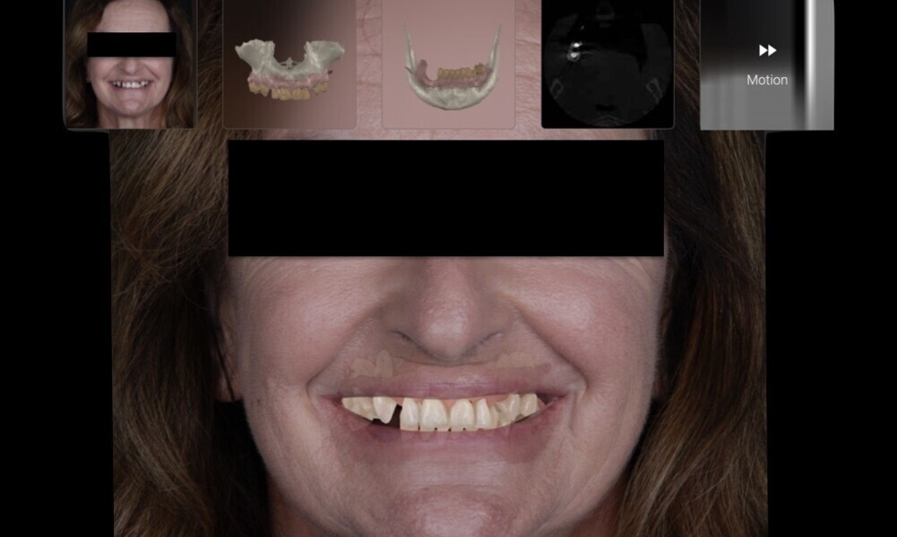 Figs. 11–15: DICOM files, STL files and clinical photographs were integrated into Smilecloud, leveraging artificial intelligence for precise, personalised smile design.