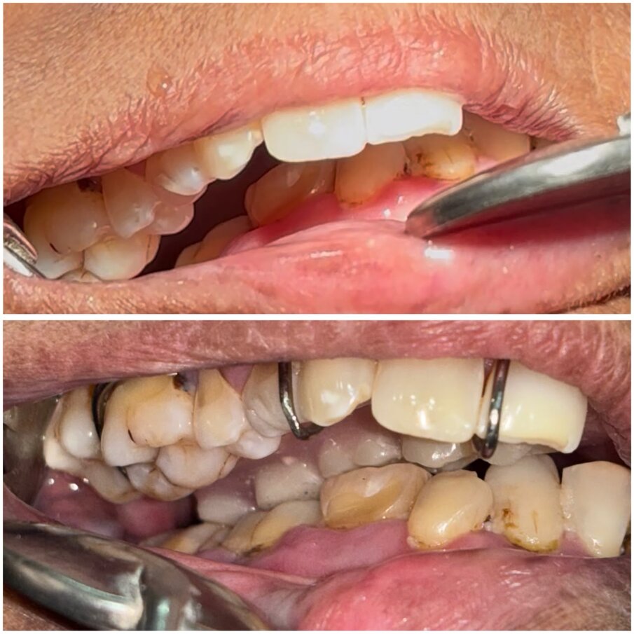Twin occlusion case 1