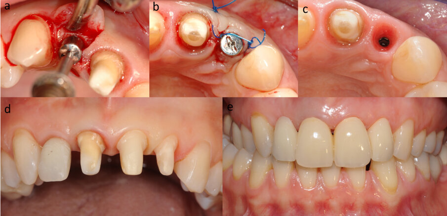 Fig. 4 - Scopertura dell’impianto (a) ed inserimento di una vite di guarigione (b), che permette un efficace condizionamento dei tessuti nei quattro mesi successivi (c), per mezzo di un provvisorio avvitato (d, e).