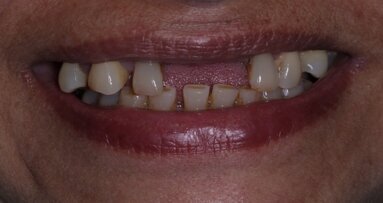 Poor dental health may indicate diabetes risk