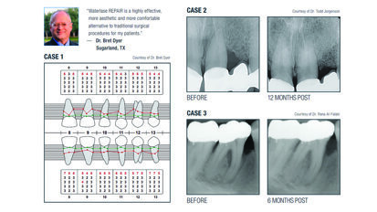 Waterlase REPAIR Perio: A minimally invasive solution for periodontitis management
