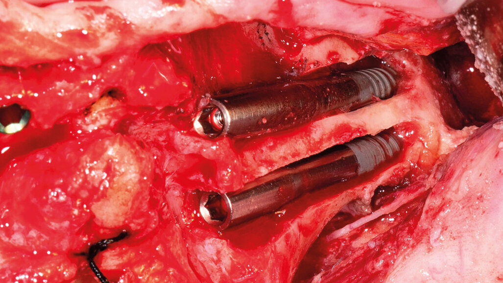 Il trattamento delle gravi atrofie mediante impianti zigomatici: una pratica per l’odontoiatra?