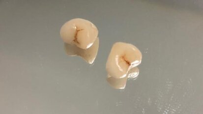 Substitution of two destructive caries with ceramic CAD/CAM crowns in one visit