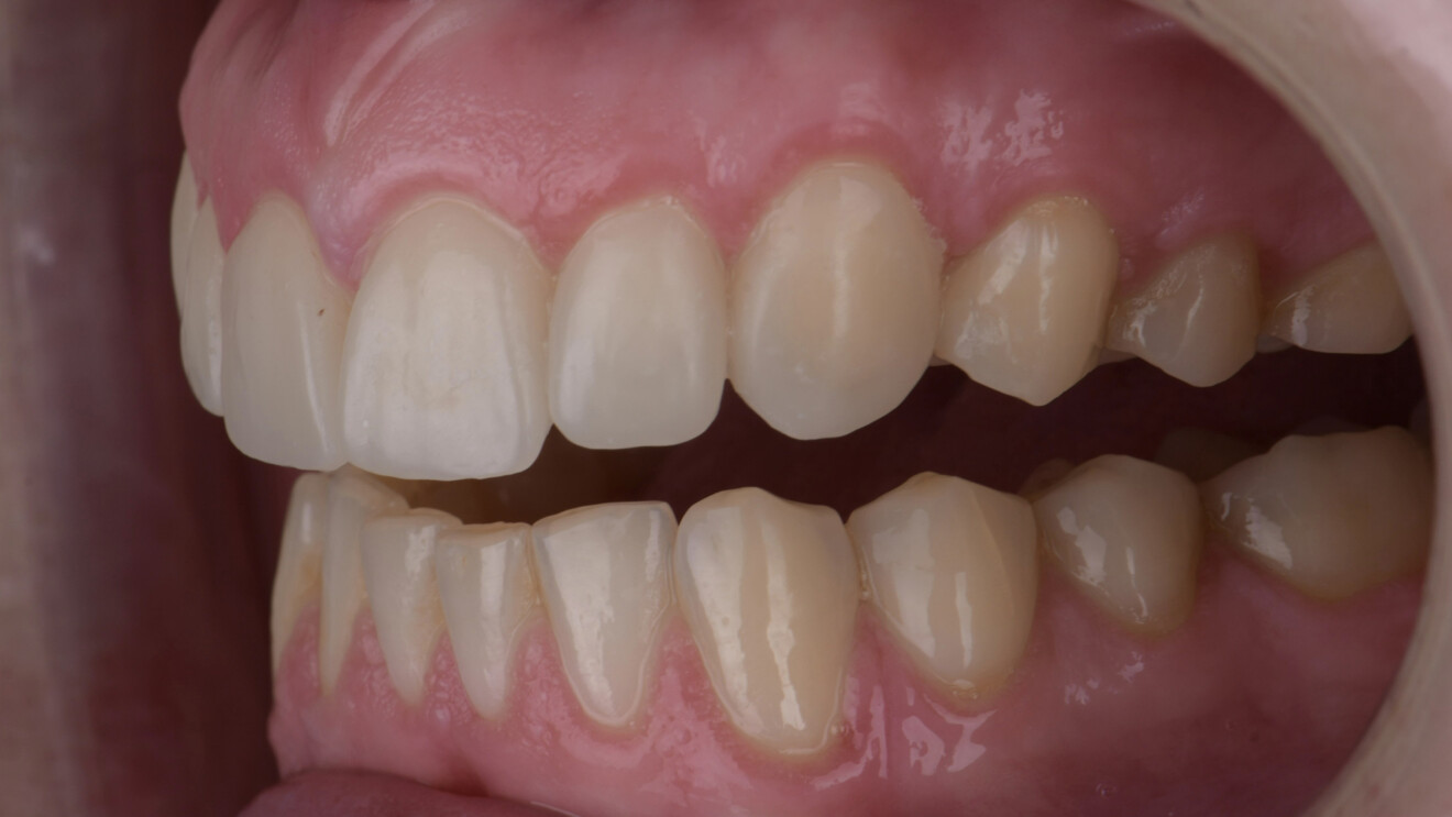 Fig. 8d: Left lateral intra-oral views with the teeth apart showing the veneer morphology and integration with the adjacent dentition.