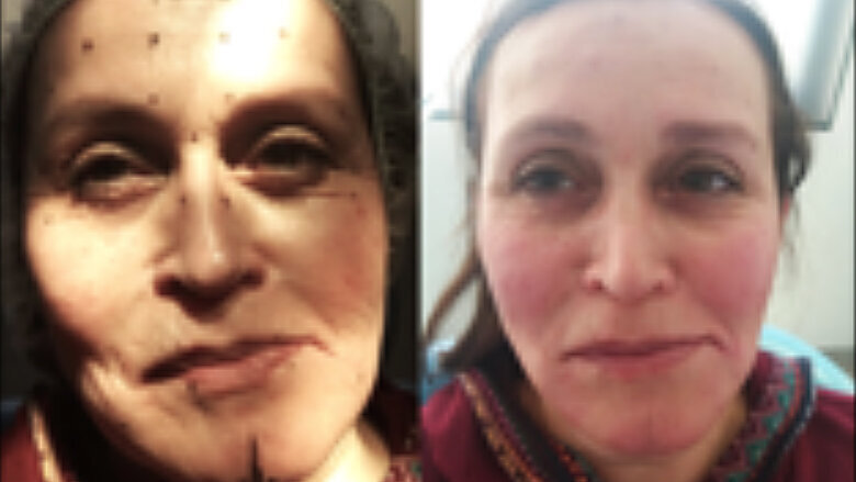 Foto 3. Rellenos aplicados (15 minutos después de foto 1), con simetrización facial y armonización. Nivelación de comisuras labiales y mejoramiento de aspecto general. Cantidad de relleno aplicado: 4 ml de ácido hialurónico de diferentes G, según compartimento tratado.