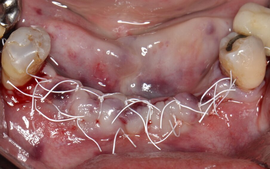 Fig. 11 - Sutura in doppia linea con filo in PTFE 4/0.