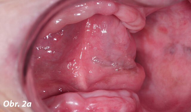 Intraorální pohled: resorbované alveolární výběžky a špatná klinická situace