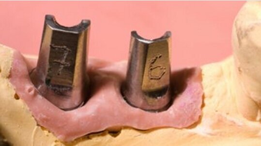 Abrechnung präparierter Implantatpfosten