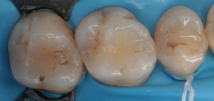 Fig. 14_Isolamento sotto diga di gomma del settore 2.