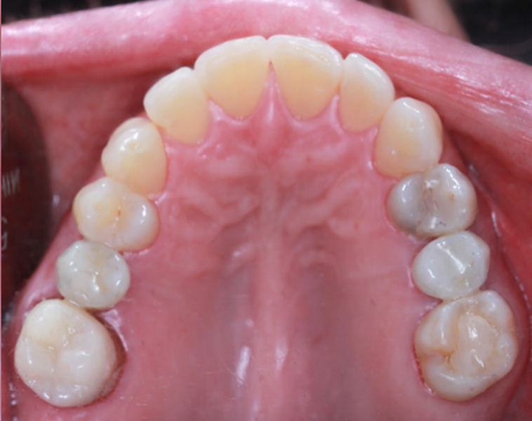 Fig. 18: Restorations finalised on both sites.