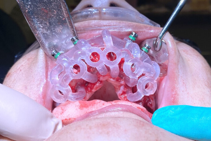 Fig. 18: Fully template-guided implants were placed.
