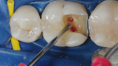 Posizionamento di MTA con il sistema MAP di Produits Dentaires (PD)