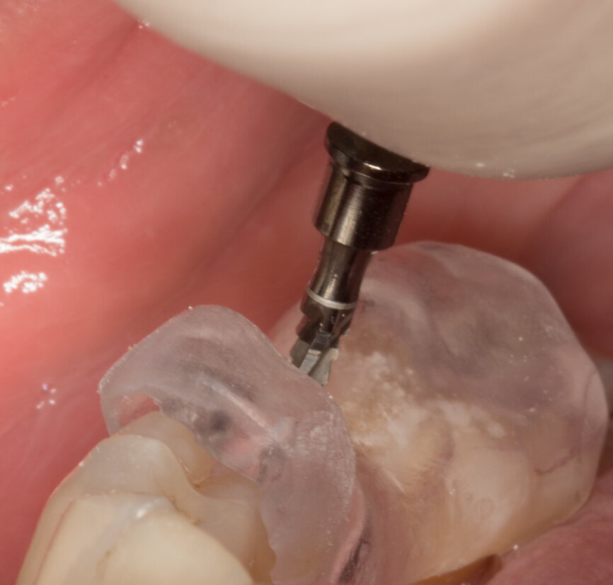 Ryc. 3_Zaznaczenie na śluzówce, przy użyciu szablonu, miejsca implantacji. 