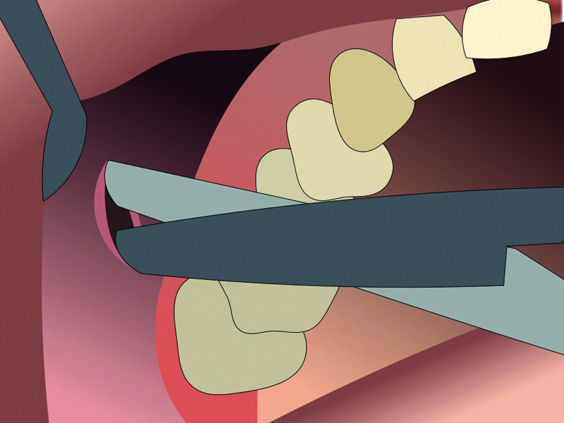 Fig. 11 : Dissection aux ciseaux à bouts ronds.