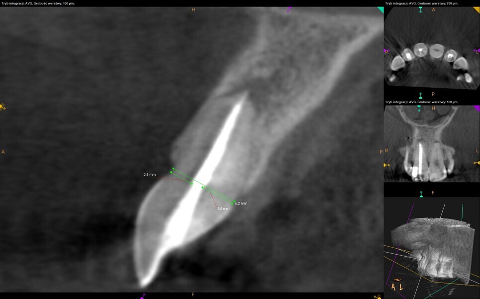 Fig. 12: CBCT check, sagittal plane. Measurement of the root thickness conrmed the size of the preparation. Healing of the periapical tissue was observed.