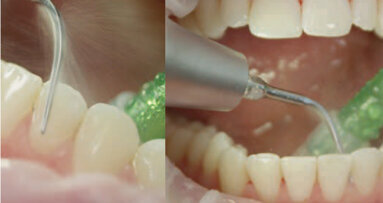 Guided Biofilm Therapy: A New Concept for Prophylaxis Professionals