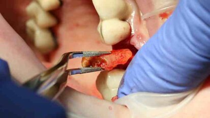 Atraumatic extraction of maxillary second premolar Atraumatic extraction of maxillary second premolar