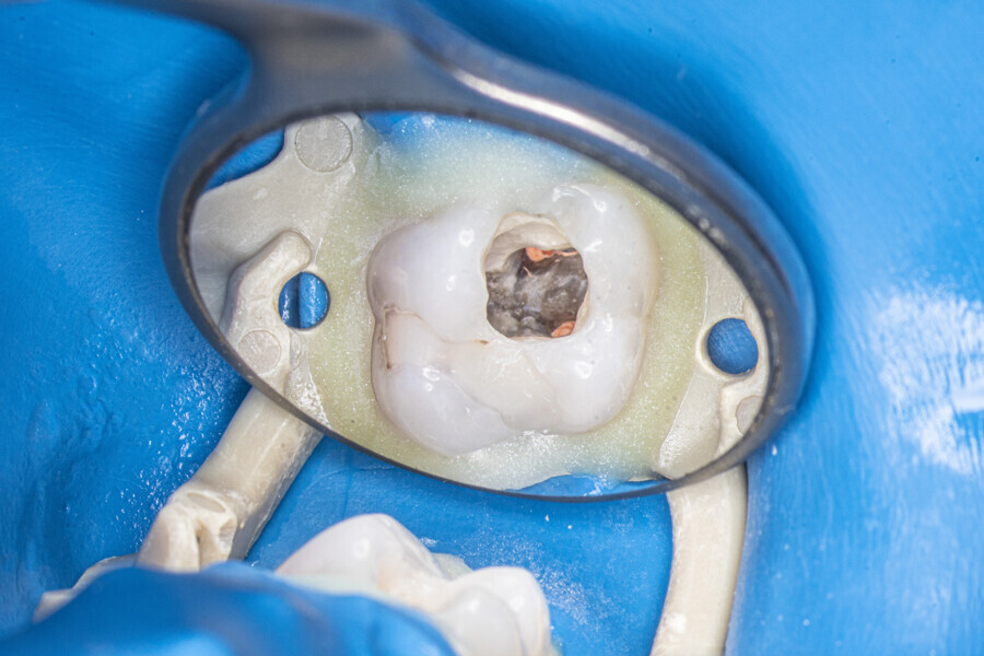 Fig. 43: The pulp chamber after root canal obturation.