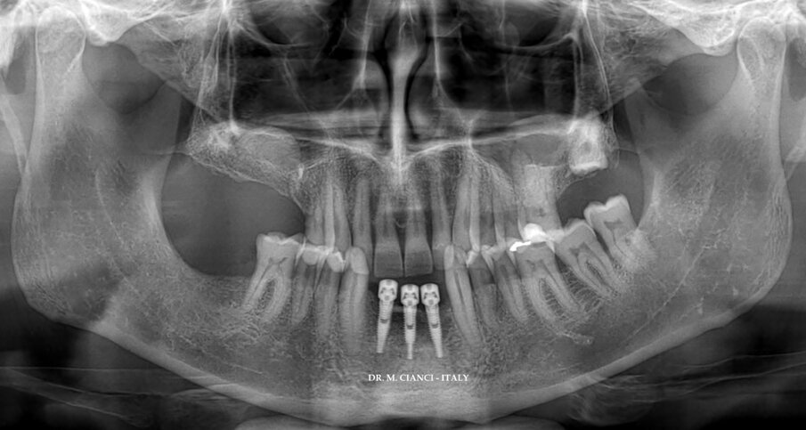 Fig. 14 - Ortopantomografia post-chirurgica.