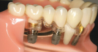 Zjednodušená metoda snímání cementovaných prací na implantátech