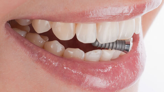 Teilimplantate für TGKK-Mitglieder