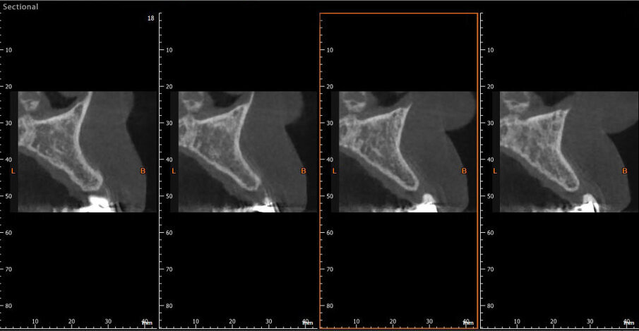 Fig. 1 - CBCT della situazione clinica iniziale.
