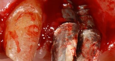 Rialzo di seno e rigenerazione ossea guidata per la riabilitazione implantare