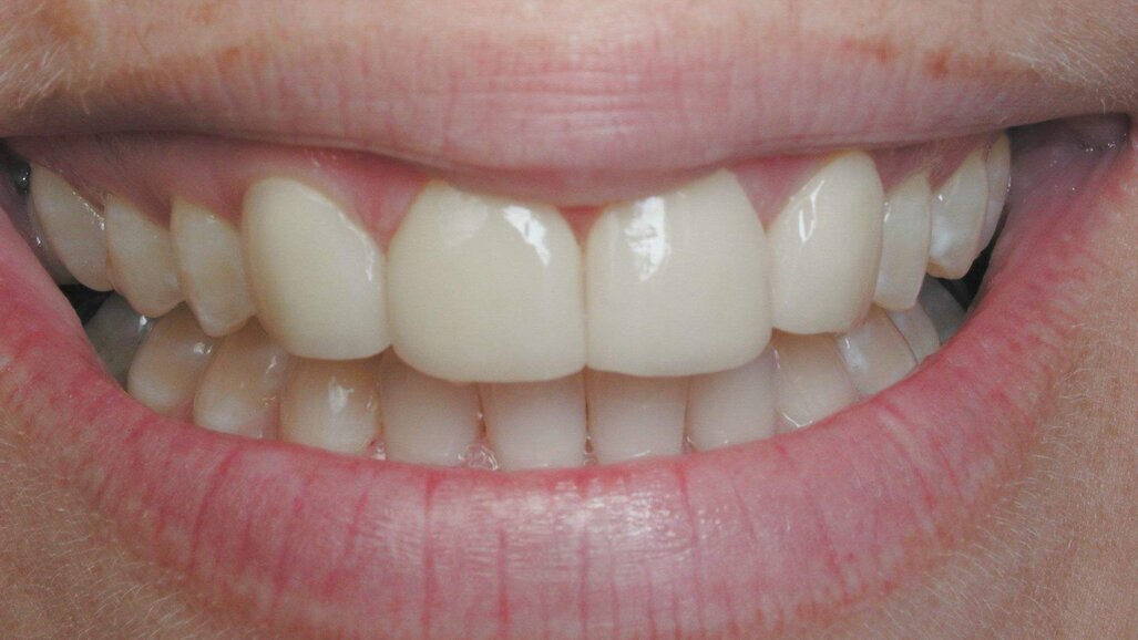 Έρχεται η «αναγέννηση» των δοντιών