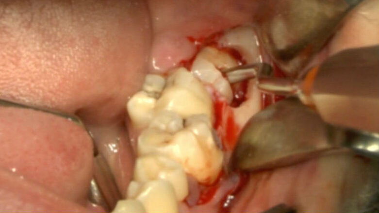 Chirurgia piezoelettrica vs strumenti rotanti nelle estrazioni dei terzi molari inferiori