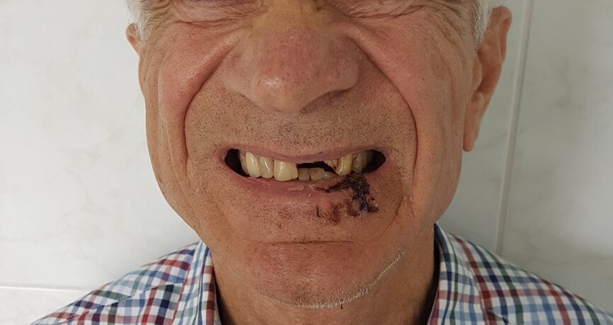 Ryc. 3_Stan po urazie.