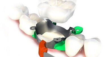Een kroon in slechts 30 minuten? ONE VISIT CROWN Rhondium!