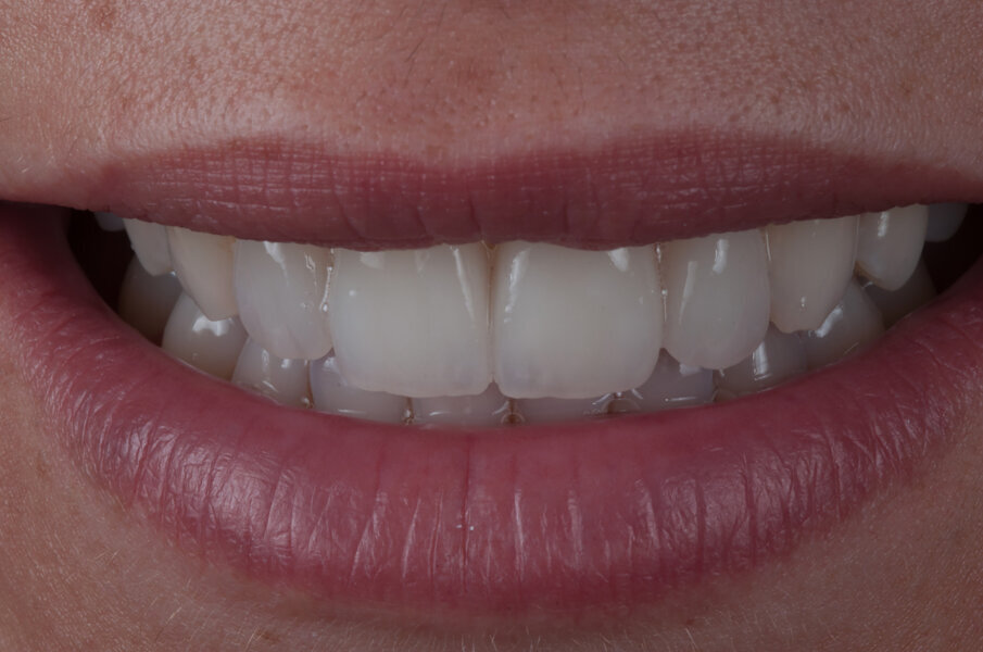 Figg. 20-23 - Restauro definitivo con tutti i dettagli della texture sui restauri in bocca.