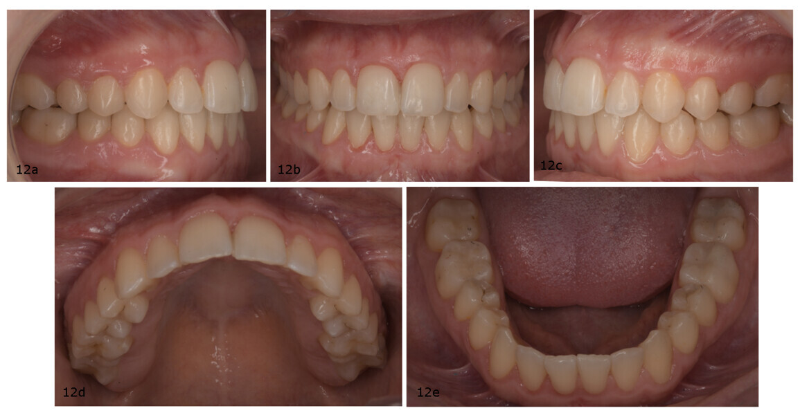 Figs. 12a–e: Post-treatment intra-oral photographs.