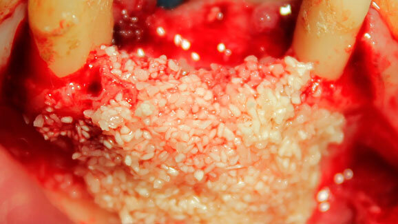 La sinergia fra materiali autologhi e eterologhi nella pratica clinica: Protocollo operativo per la gestione dei derivati ematici in associazione a biomateriali (Hypro-Oss®)