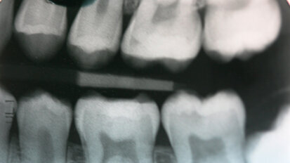 Riabilitazione conservativa con tecnica diretta e indiretta: case report
