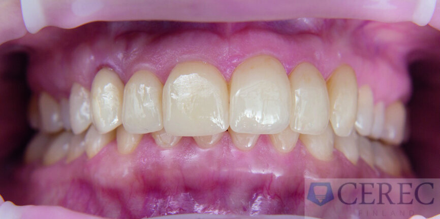 Fig. 6: …and after placement of the veneers in the maxilla.