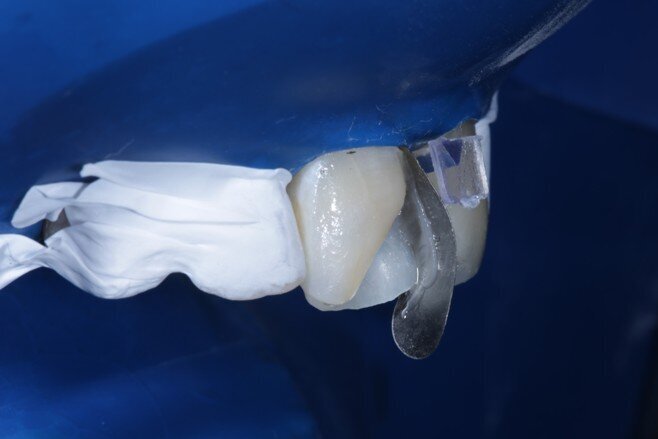 Fig 10 Enamel shade for proximal box layering