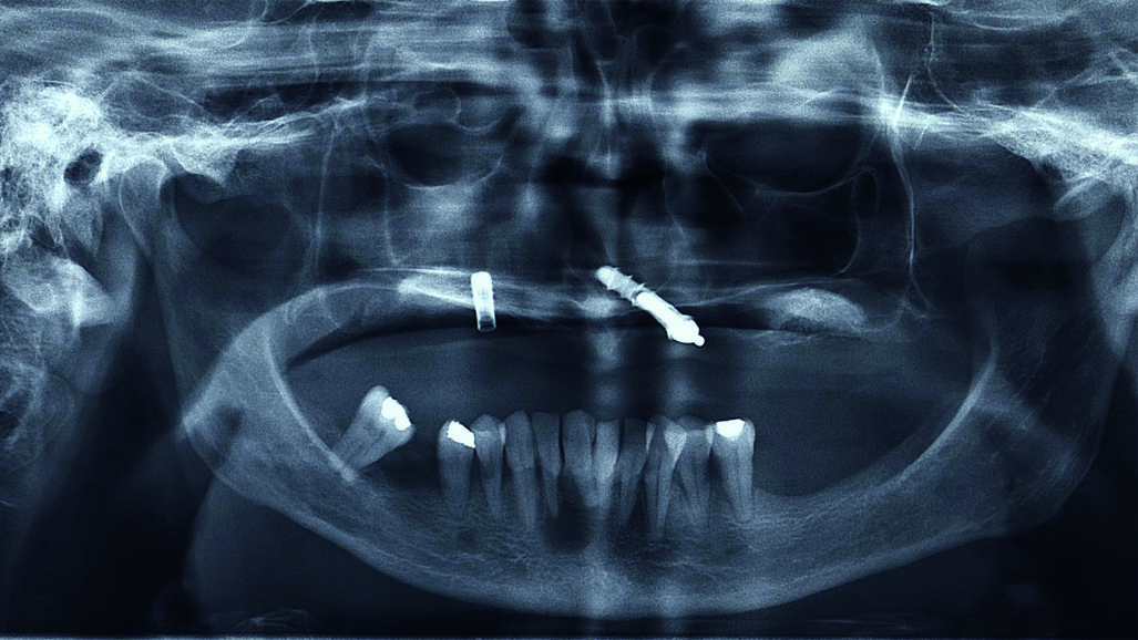 Estetica e funzione: approccio moderno alla riabilitazione del paziente totalmente edentulo