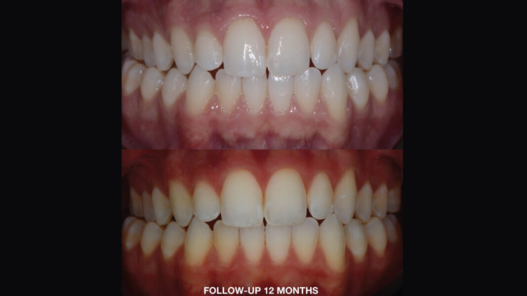 Figg. 12, 13 - Follow-up a 12 mesi.