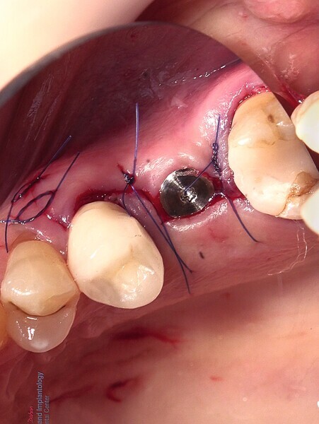 Fig. 43 : Microsutures. 