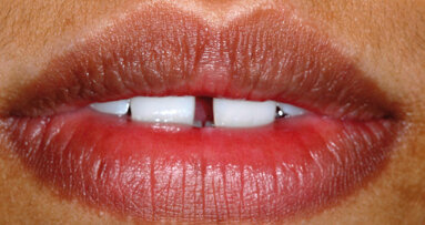 Diastema mediana - zatvaranje korišćenjem direktnih adhezivnih restauracija